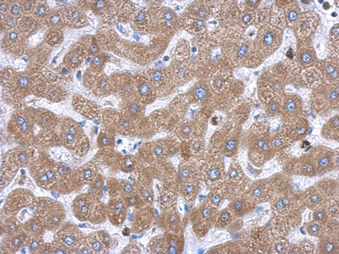 Immunohistochemistry-Paraffin: TBP like protein TLP Antibody [NBP1-31133] - Paraffin-embedded hepatoma, using antibody at 1:500 dilution.