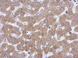 Immunohistochemistry-Paraffin: TBP like protein TLP Antibody [NBP1-31133] - Paraffin-embedded hepatoma, using antibody at 1:500 dilution.