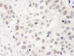 Immunohistochemistry-Paraffin: DKFZP434B168 Antibody [NB100-465] - FFPE section of human breast carcinoma   Affinity purified rabbit anti-INT7 used at a dilution of 1:250.  Detection: DAB staining using Immunohistochemistry Accessory Kit