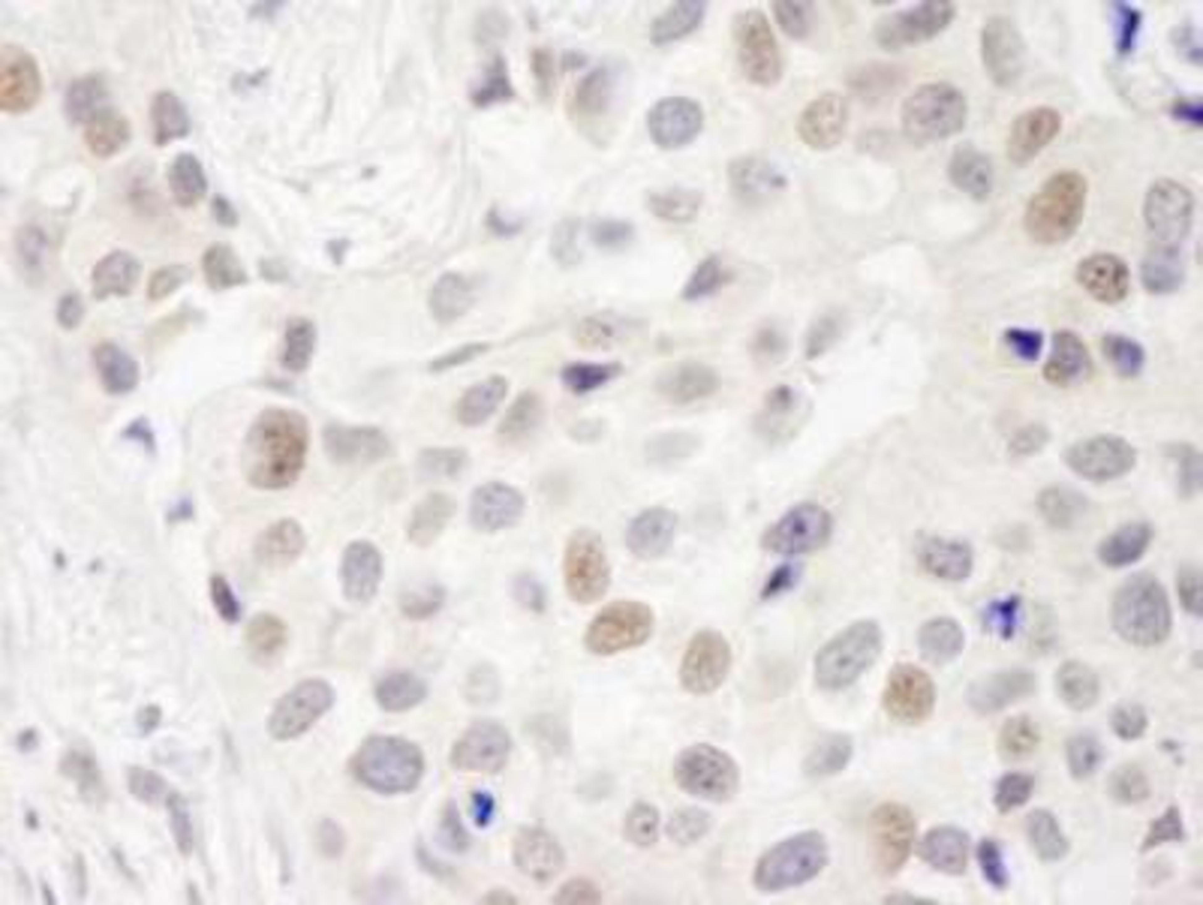 Immunohistochemistry-Paraffin: DKFZP434B168 Antibody [NB100-465] - FFPE section of human breast carcinoma   Affinity purified rabbit anti-INT7 used at a dilution of 1:250.  Detection: DAB staining using Immunohistochemistry Accessory Kit