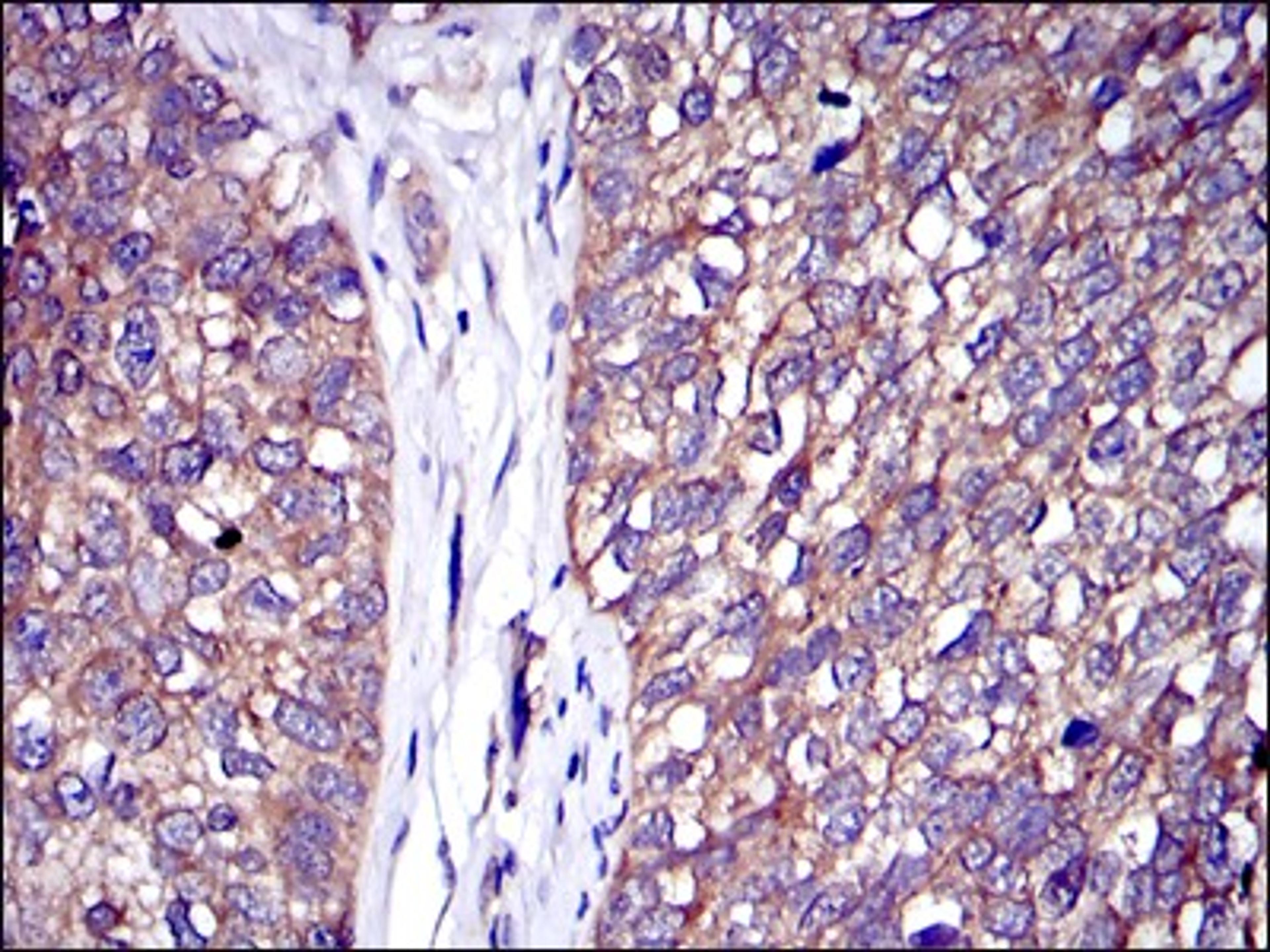 Immunohistochemistry: CBL Antibody (3B12) [NBP2-37574] - Immunohistochemical analysis of paraffin-embedded bladder cancer tissues using C-CBL mouse mAb with DAB staining.