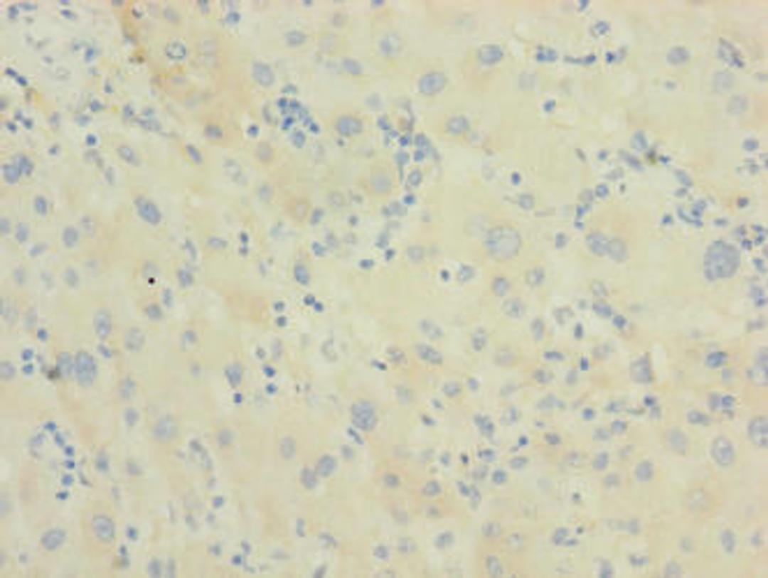 Immunohistochemistry of paraffin-embedded human liver cancer using CSB-PA819454LA01HU at dilution of 1:100