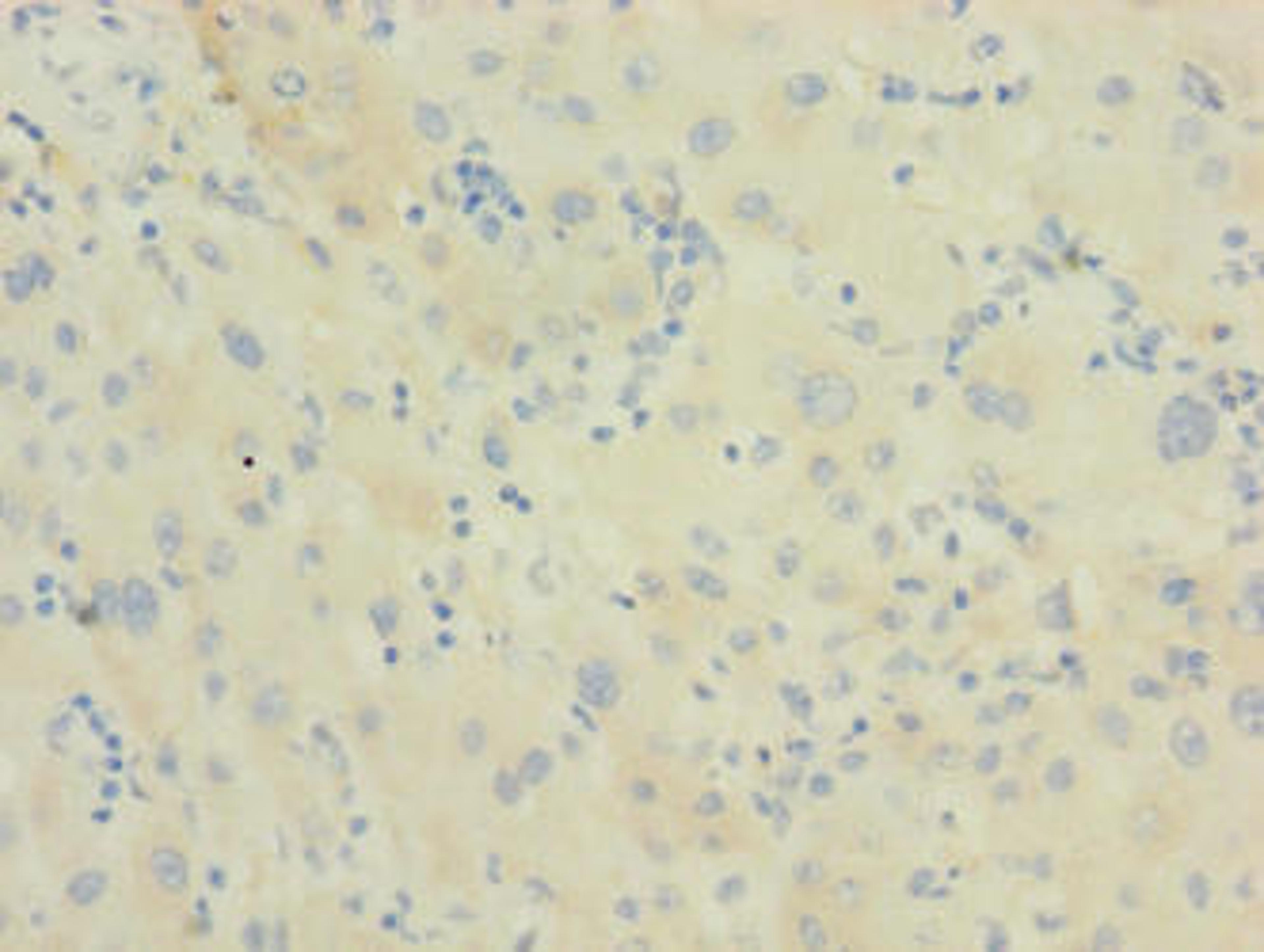 Immunohistochemistry of paraffin-embedded human liver cancer using CSB-PA819454LA01HU at dilution of 1:100