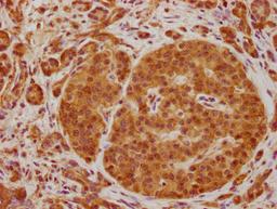 IHC image of CSB-PA740238OA01HU diluted at 1:100 and staining in paraffin-embedded human pancreatic cancer performed on a Leica BondTM system. After dewaxing and hydration, antigen retrieval was mediated by high pressure in a citrate buffer (pH 6.0). Section was blocked with 10% normal goat serum 30min at RT. Then primary antibody (1% BSA) was incubated at 4°C overnight. The primary is detected by a biotinylated secondary antibody and visualized using an HRP conjugated SP system.