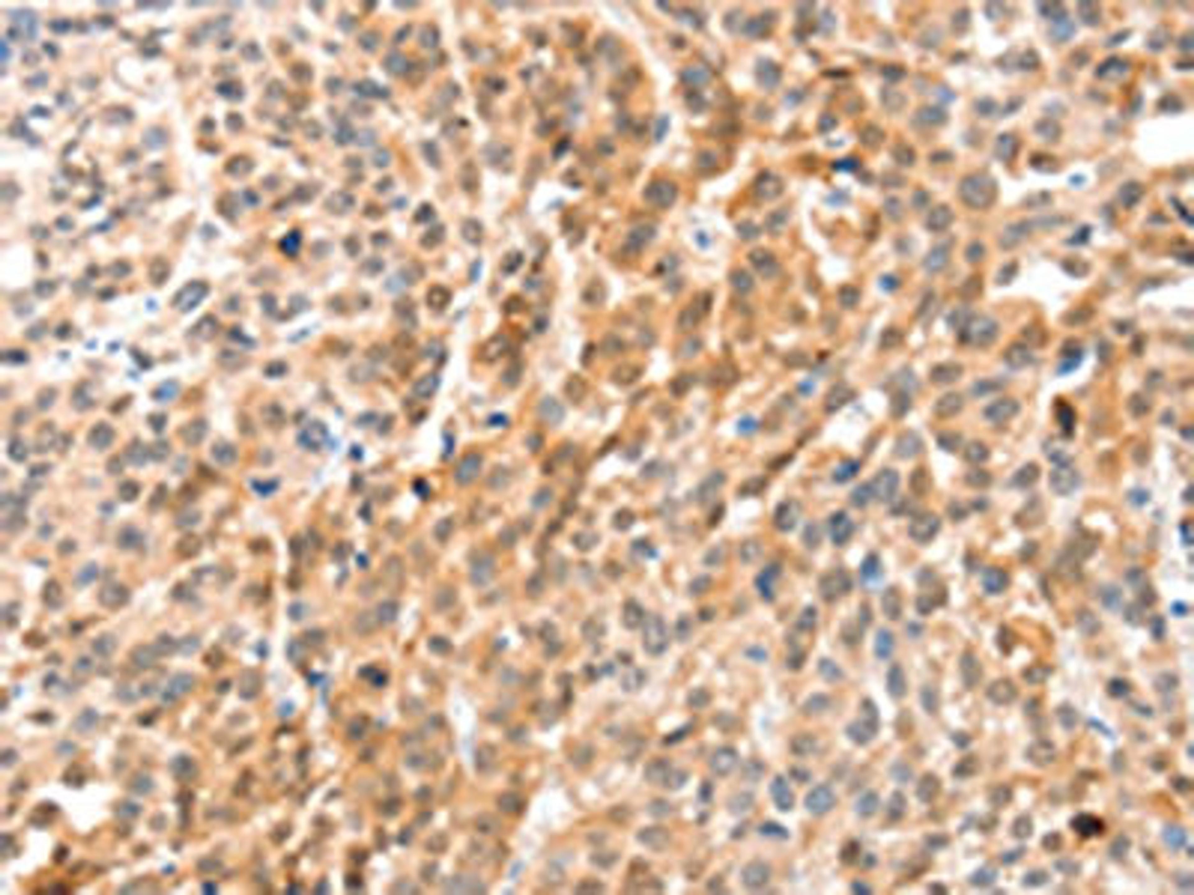 The image on the left is immunohistochemistry of paraffin-embedded Human esophagus cancer tissue using CSB-PA441788(ANXA8 Antibody) at dilution 1/35, on the right is treated with fusion protein. (Original magnification: ×200)