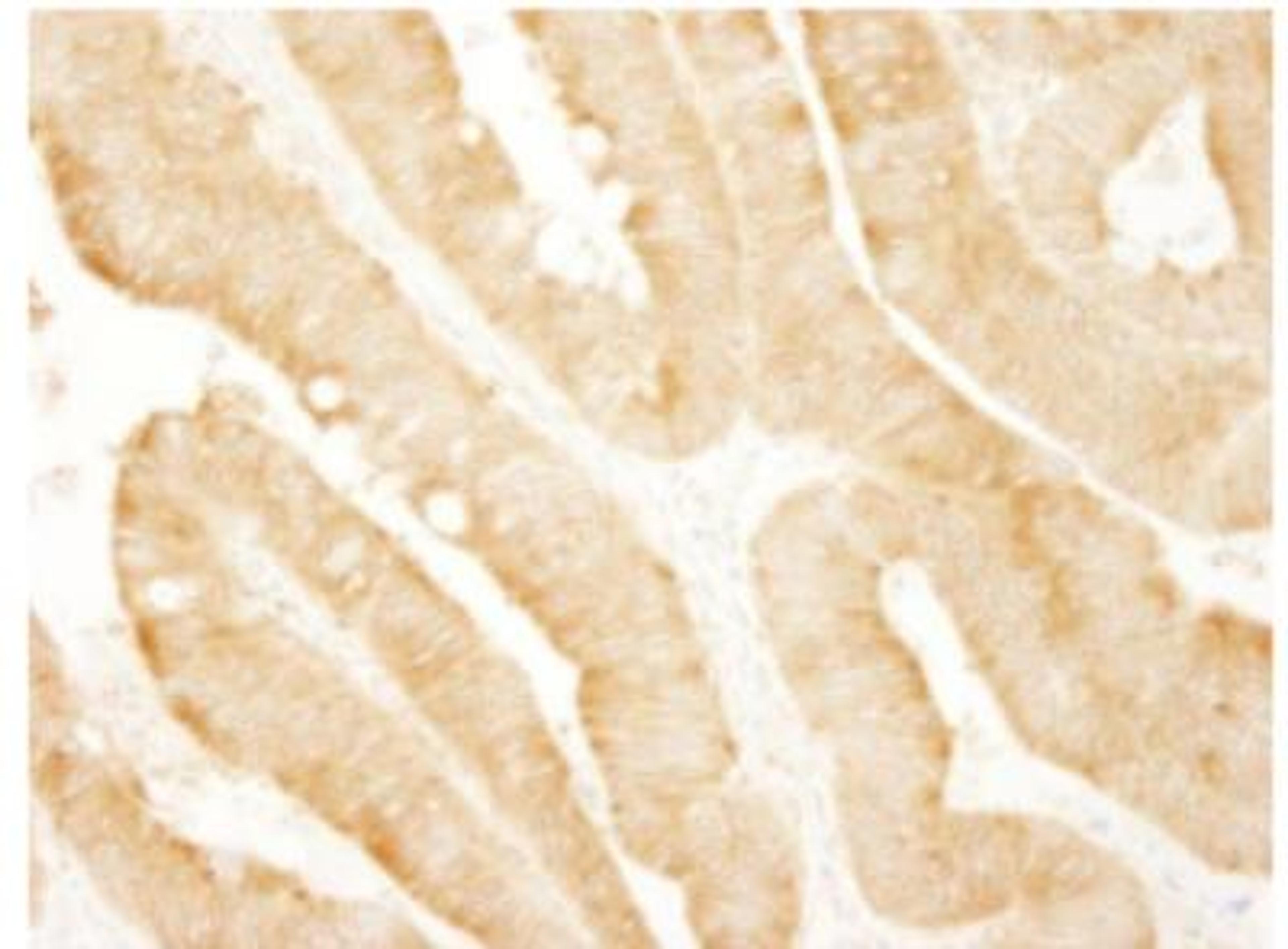 Immunohistochemistry-Paraffin: PARP4 Antibody [NBP1-06563] - Human colon carcinoma.