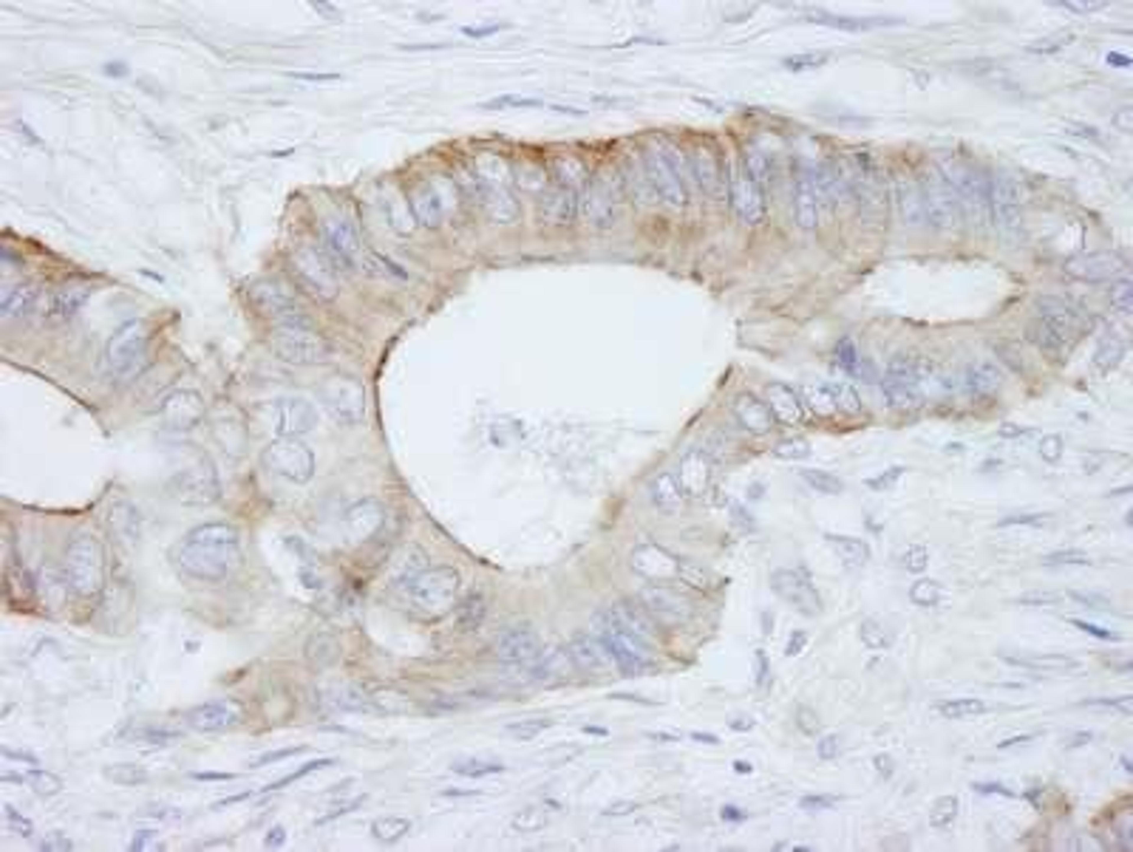 Immunohistochemistry-Paraffin: Spectrin beta 2 Antibody [NB100-40829] - FFPE section of human colon adenocarcinoma.  Antibody: Affinity purified rabbit anti-SPTBN1 used at a dilution of 1:250.