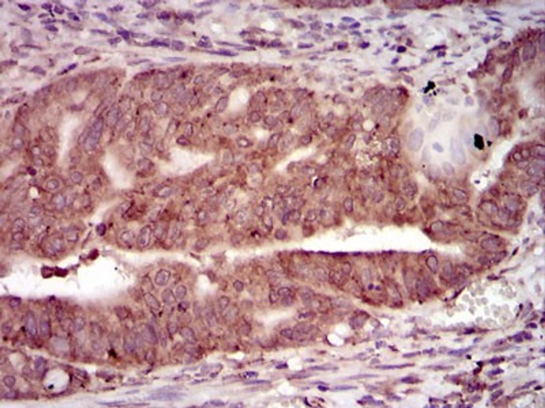 Immunohistochemistry: PKA C-gamma Antibody (2E4) [NBP2-37487] - Immunohistochemical analysis of paraffin-embedded rectum cancer tissues using PRKACG mouse mAb with DAB staining.