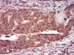 Immunohistochemistry: PKA C-gamma Antibody (2E4) [NBP2-37487] - Immunohistochemical analysis of paraffin-embedded rectum cancer tissues using PRKACG mouse mAb with DAB staining.