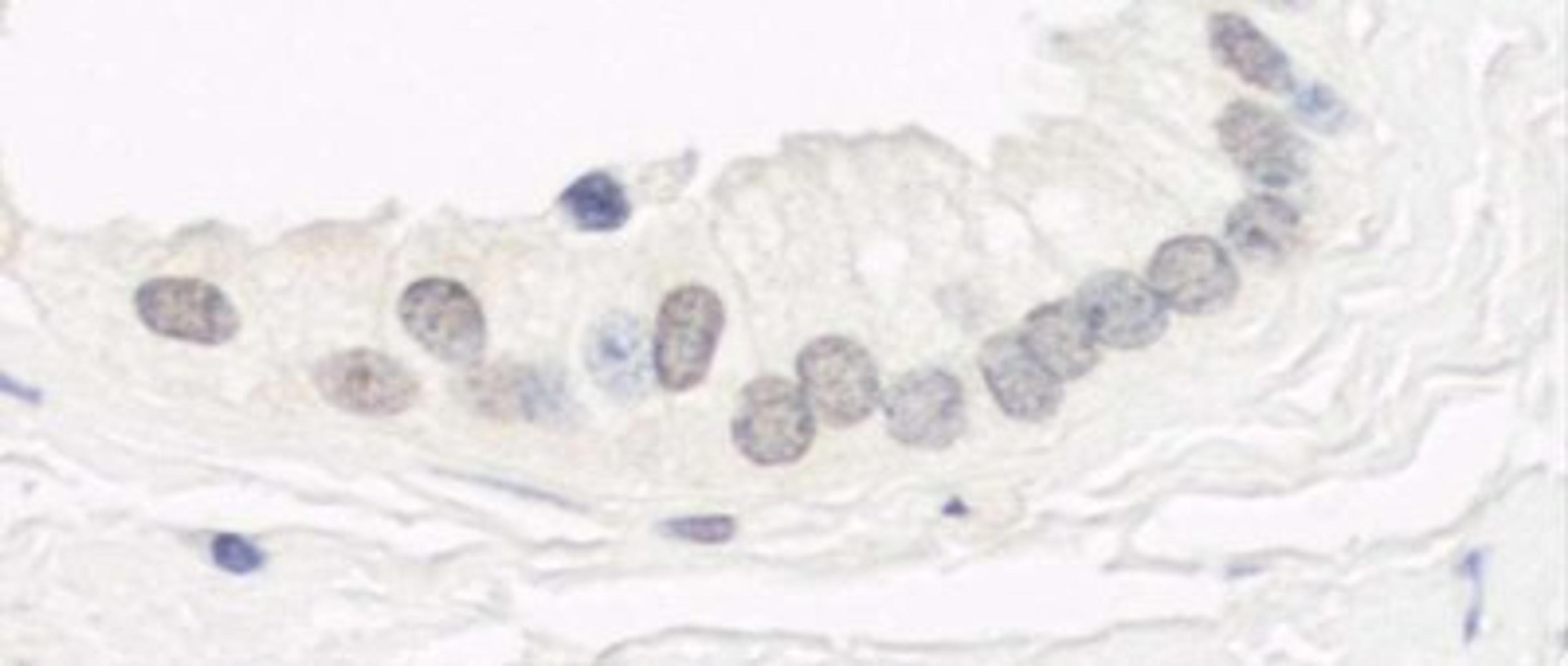 Immunohistochemistry-Paraffin: GSG2 Antibody [NBP1-26626] - Human prostate carcinoma.  Antibody used at a dilution of 1:200.