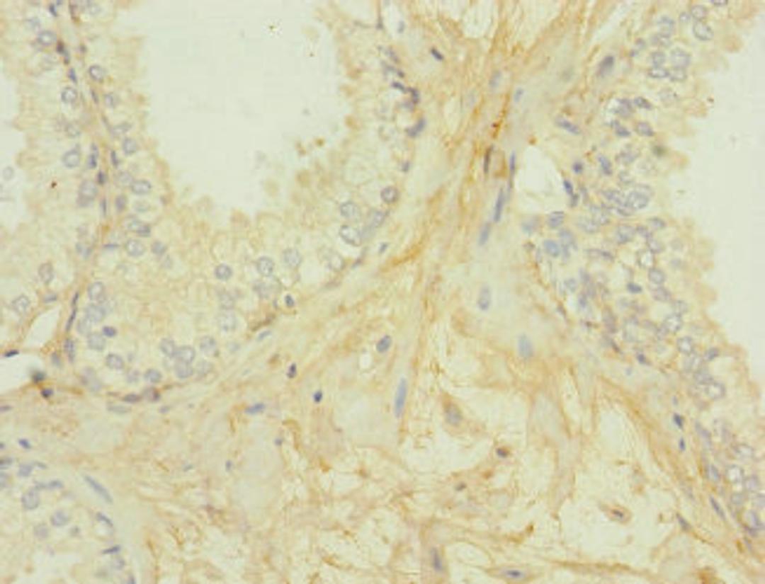 Immunohistochemistry of paraffin-embedded human prostate cancer using CSB-PA009438ESR2HU at dilution of 1:100