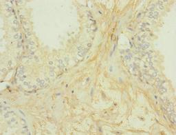 Immunohistochemistry of paraffin-embedded human prostate cancer using CSB-PA009438ESR2HU at dilution of 1:100