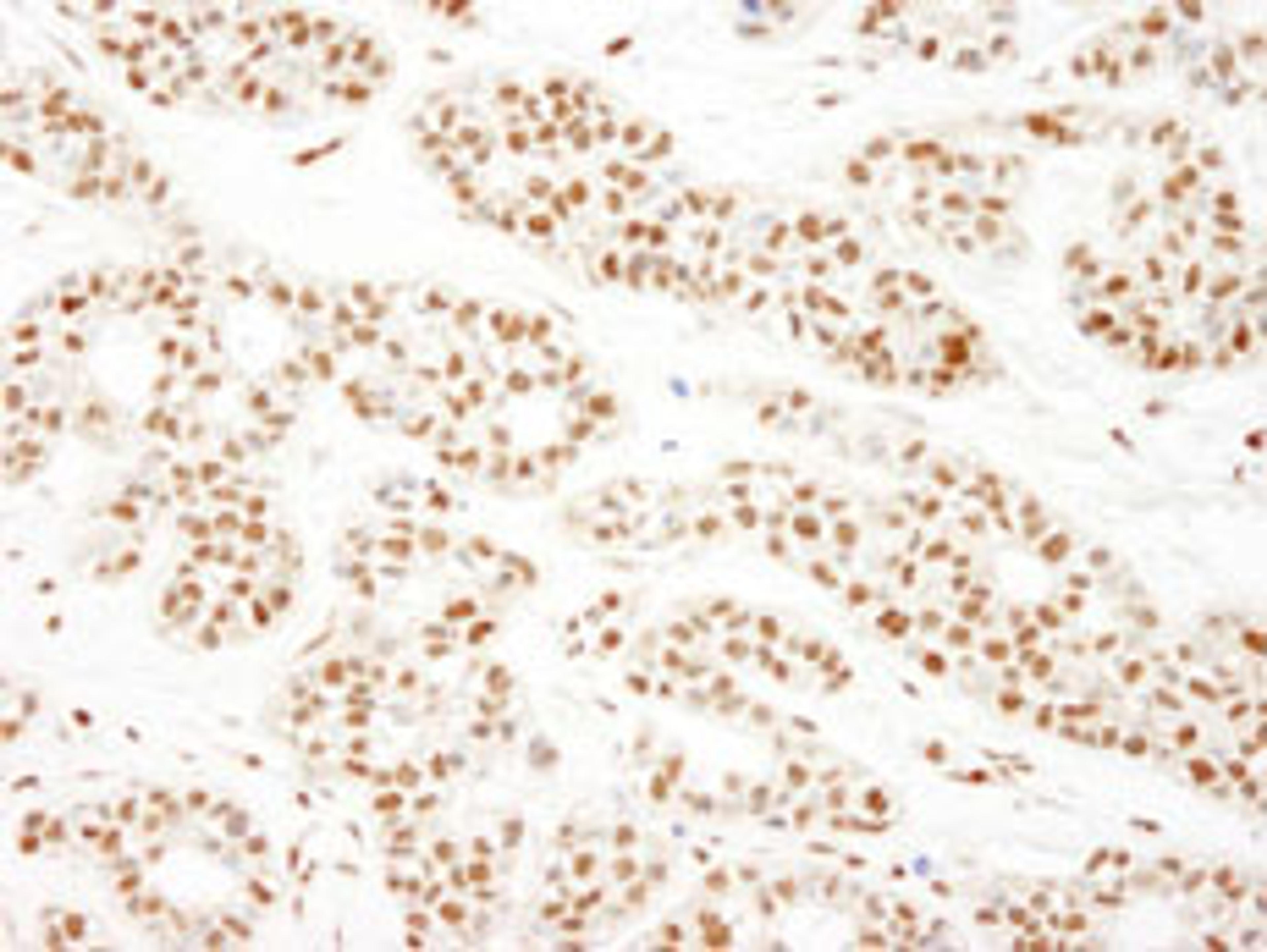 Detection of human KSRP by immunohistochemistry.