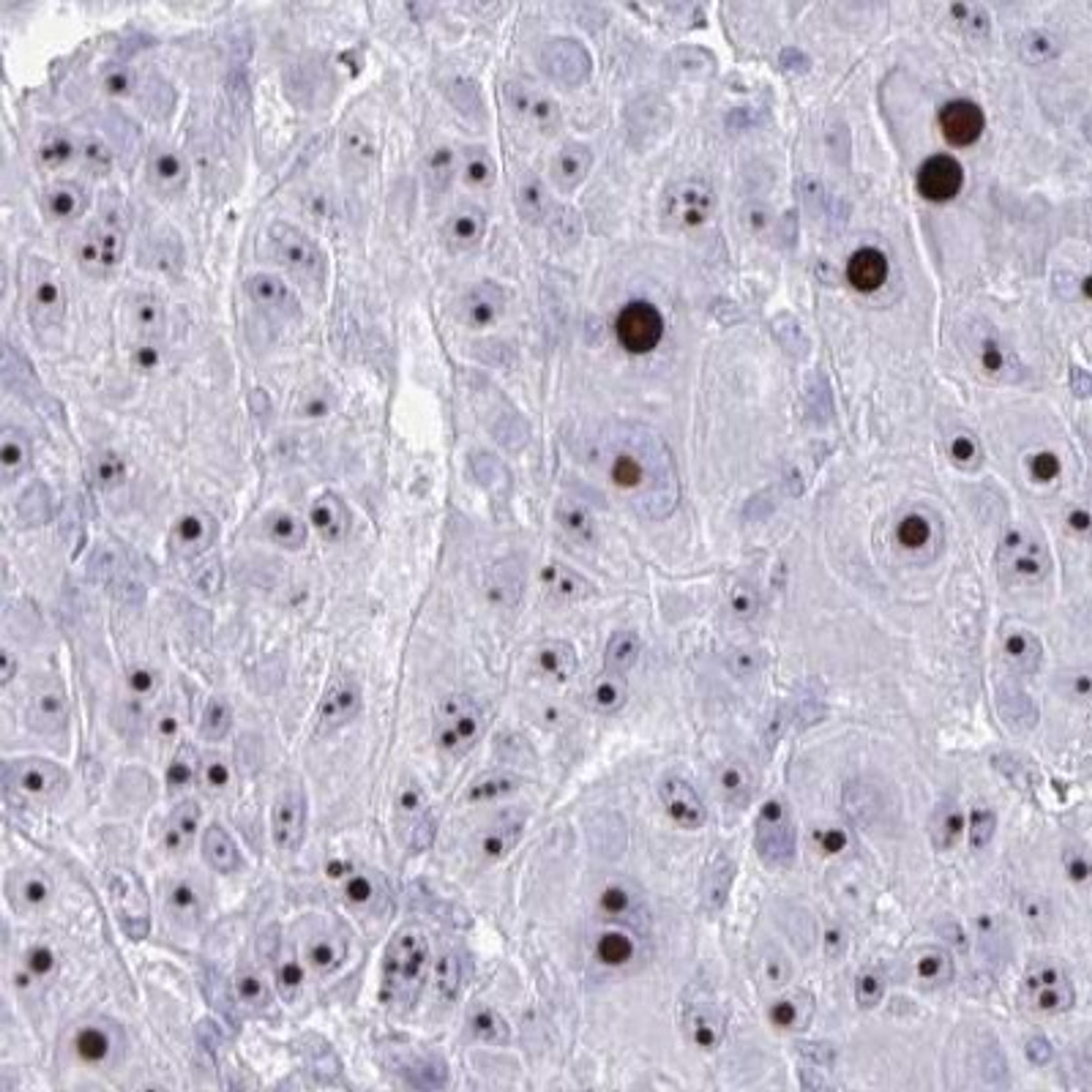 Immunohistochemistry: DLK2 Antibody [NBP2-31847] - liver cancer