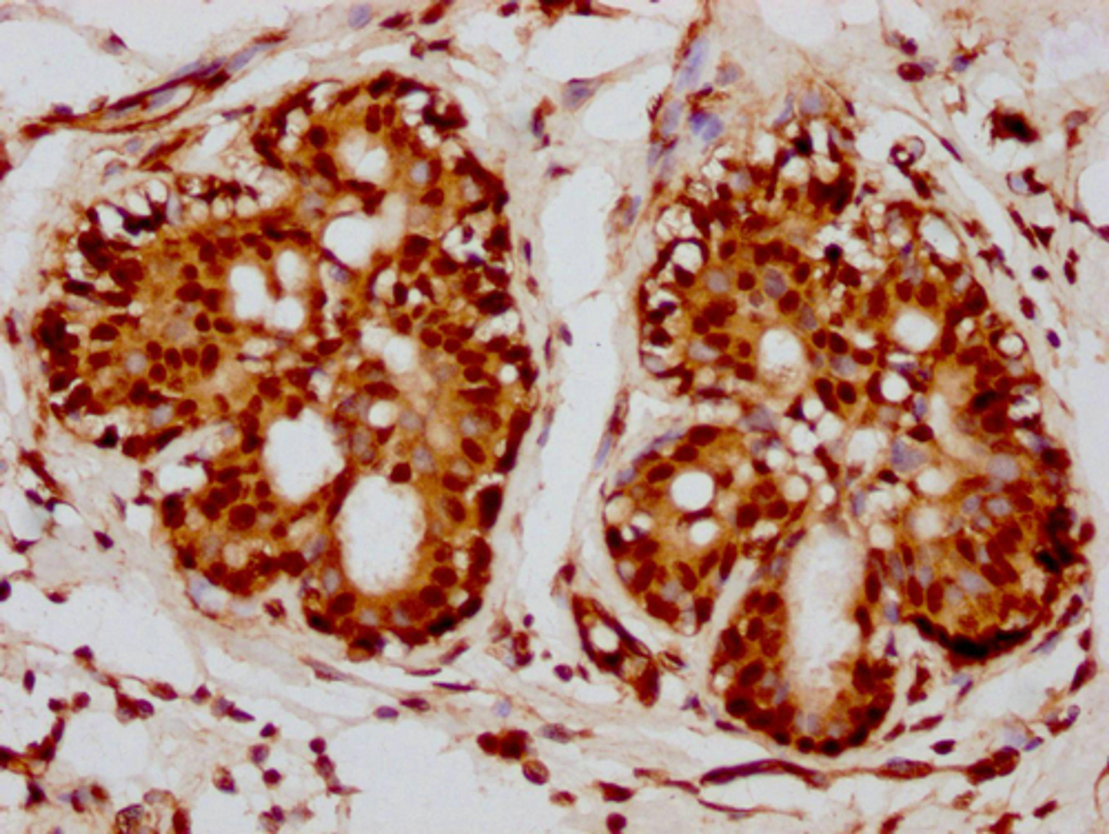 IHC image of CSB-PA010418PA115nacHU diluted at 1:10 and staining in paraffin-embedded human breast cancer performed on a Leica BondTM system. After dewaxing and hydration, antigen retrieval was mediated by high pressure in a citrate buffer (pH 6.0). Section was blocked with 10% normal goat serum 30min at RT. Then primary antibody (1% BSA) was incubated at 4°C overnight. The primary is detected by a biotinylated secondary antibody and visualized using an HRP conjugated SP system.