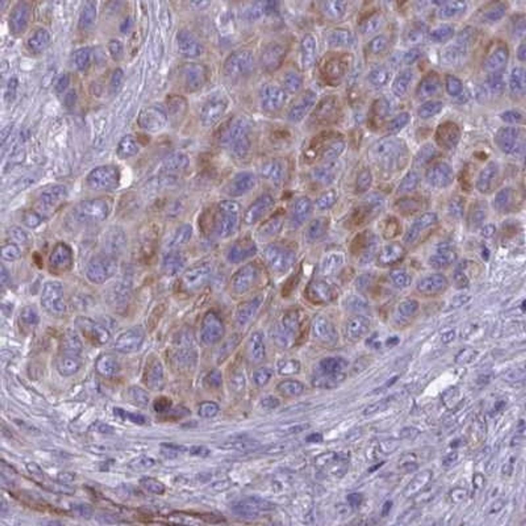 Immunohistochemistry: TMEM86B Antibody [NBP2-31684] - melanoma