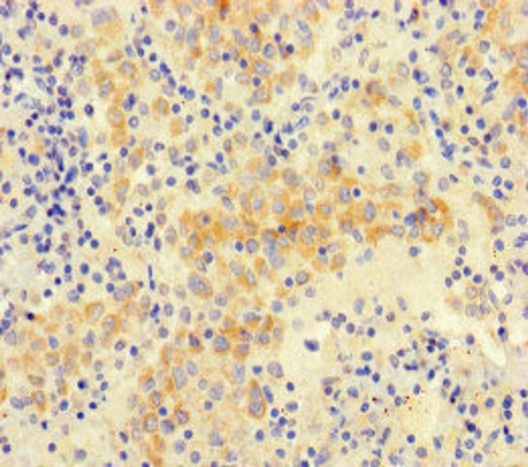 Immunohistochemistry of paraffin-embedded human lung cancer using CSB-PA852917LA01HU at dilution of 1:100