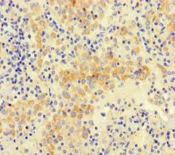 Immunohistochemistry of paraffin-embedded human lung cancer using CSB-PA852917LA01HU at dilution of 1:100