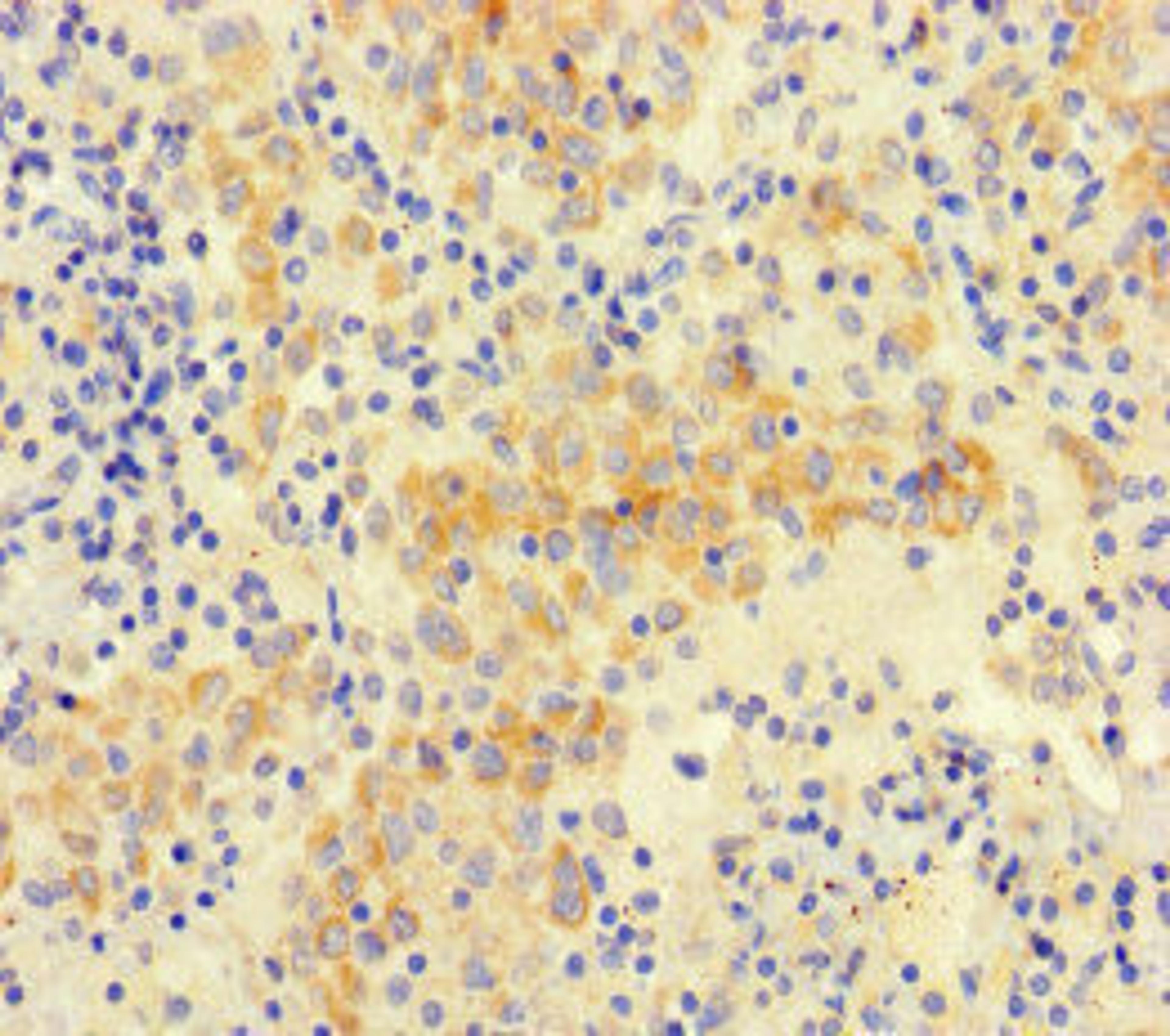 Immunohistochemistry of paraffin-embedded human lung cancer using CSB-PA852917LA01HU at dilution of 1:100