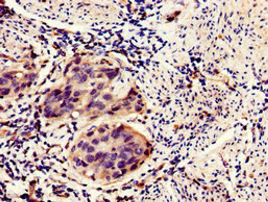 Immunohistochemistry of paraffin-embedded human bladder cancer using CSB-PA872492LA01HU at dilution of 1:100