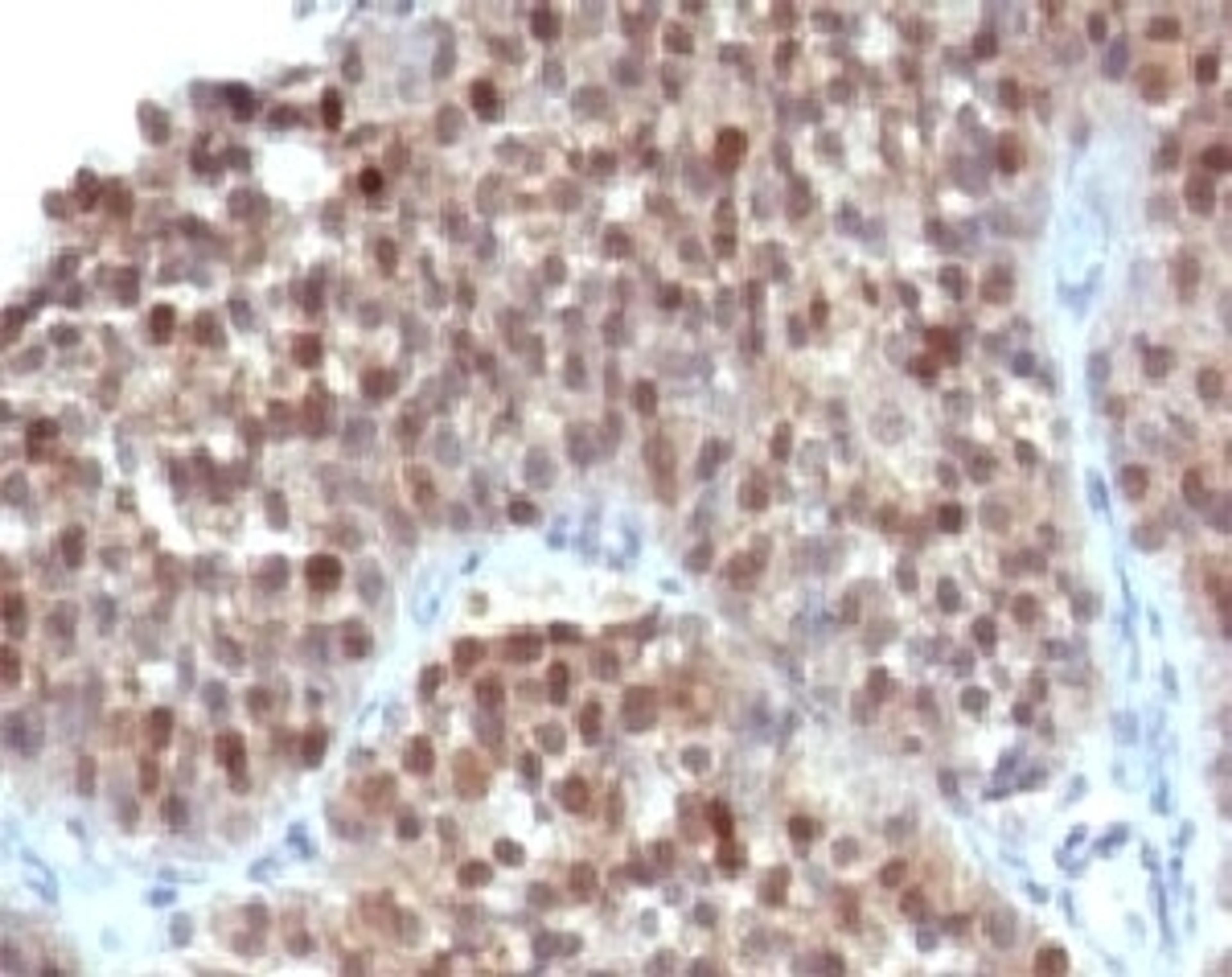 IHC testing of human bladder carcinoma and p21 antibody (WAF21-1).