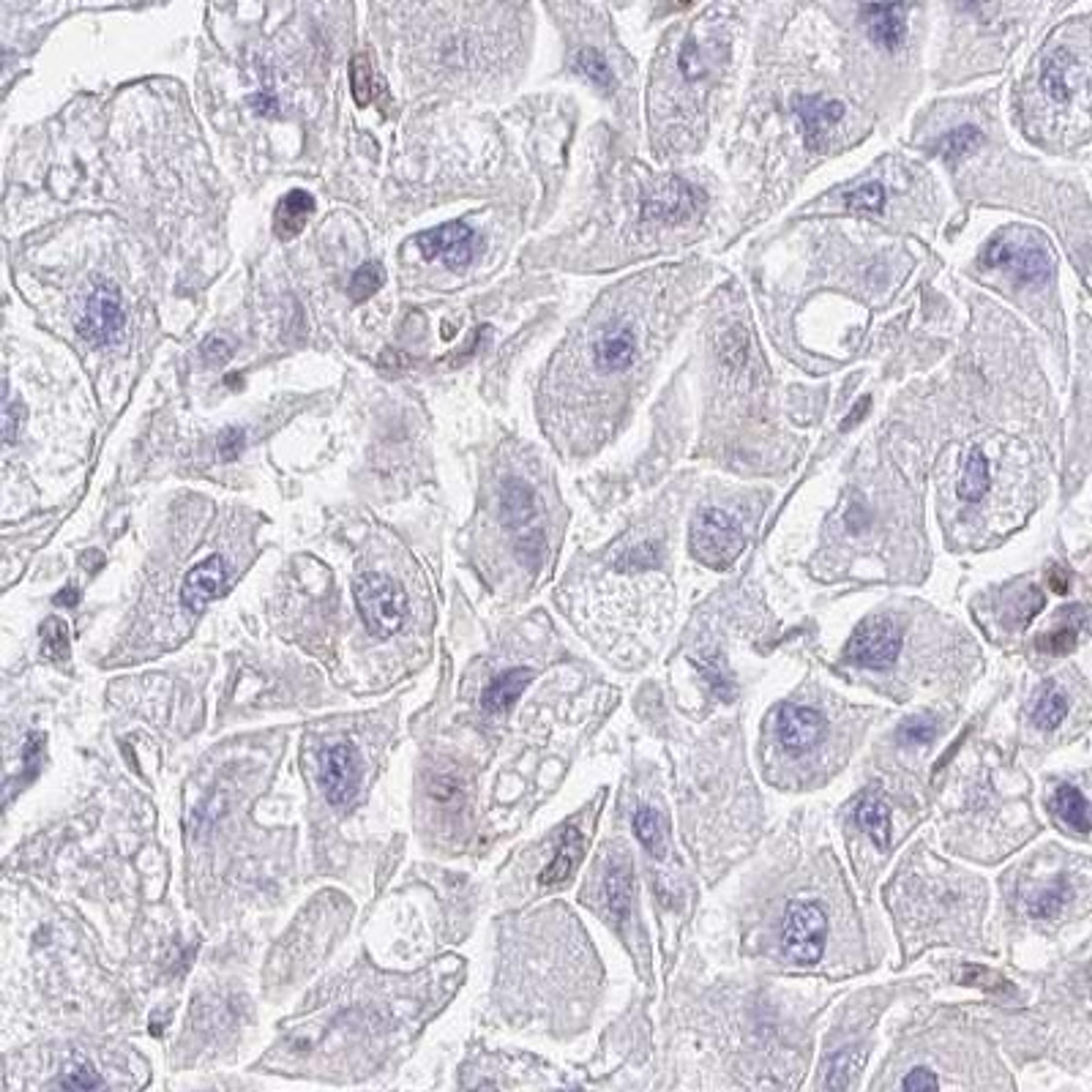 Immunohistochemistry: RAB9B Antibody [NBP2-31854] - liver cancer