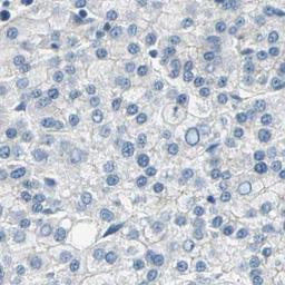 Immunohistochemistry: LGR6 Antibody [NBP2-33864] - liver cancer