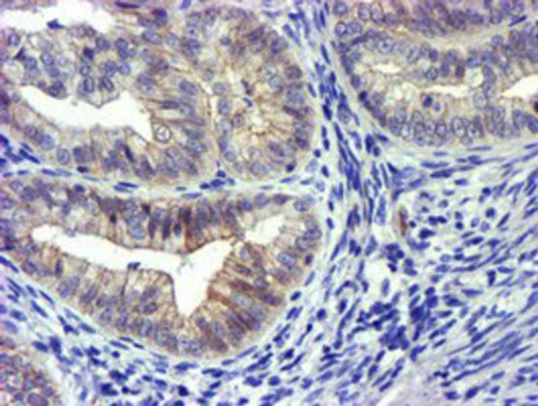 Immunohistochemistry-Paraffin: GSTO2 Antibody (2A12) [NBP2-01626] - Staining of paraffin-embedded Adenocarcinoma of Human endometrium tissue using anti-GSTO2 mouse monoclonal antibody.