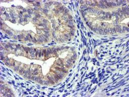 Immunohistochemistry-Paraffin: GSTO2 Antibody (2A12) [NBP2-01626] - Staining of paraffin-embedded Adenocarcinoma of Human endometrium tissue using anti-GSTO2 mouse monoclonal antibody.