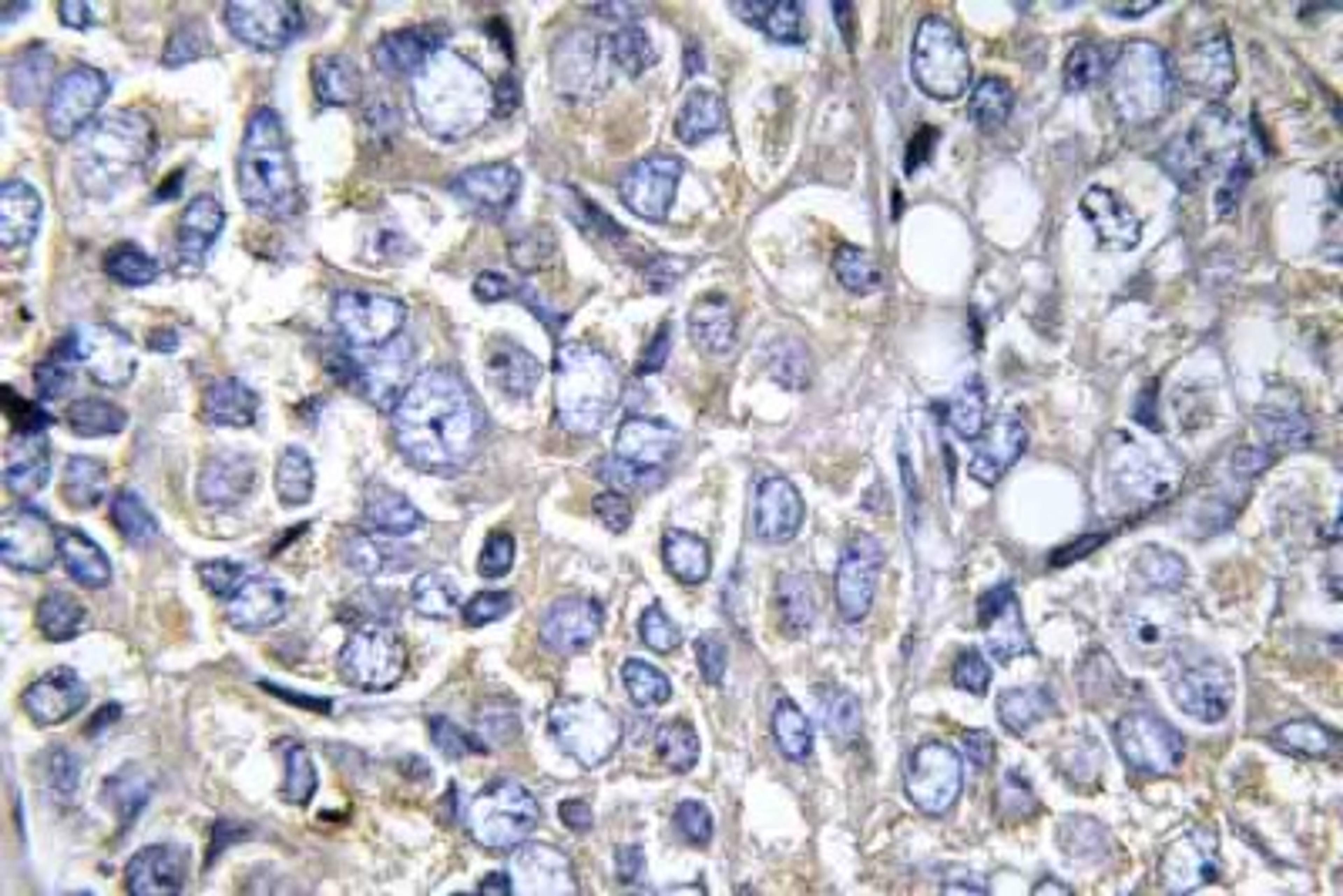 Immunohistochemistry-Paraffin: Cortactin Antibody [NBP1-51464] - Human prostate carcinoma tissue.