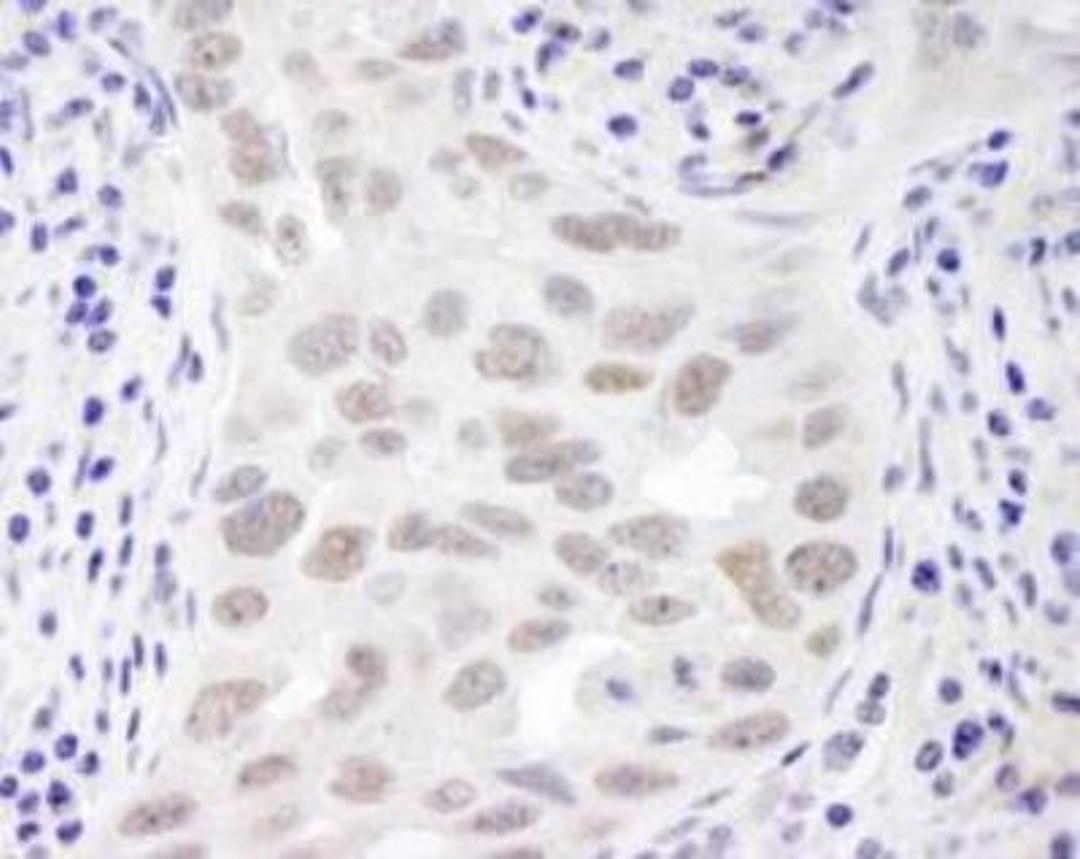 Immunohistochemistry-Paraffin: EMSY Antibody [NB100-545] - Section of human breast carcinoma.