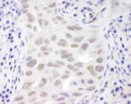 Immunohistochemistry-Paraffin: EMSY Antibody [NB100-545] - Section of human breast carcinoma.