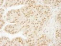 Immunohistochemistry-Paraffin: USP15 Antibody [NB110-40690] - FFPE section of human ovarian carcinoma.  Affinity purified rabbit anti-USP15 used at a dilution of 1:100.