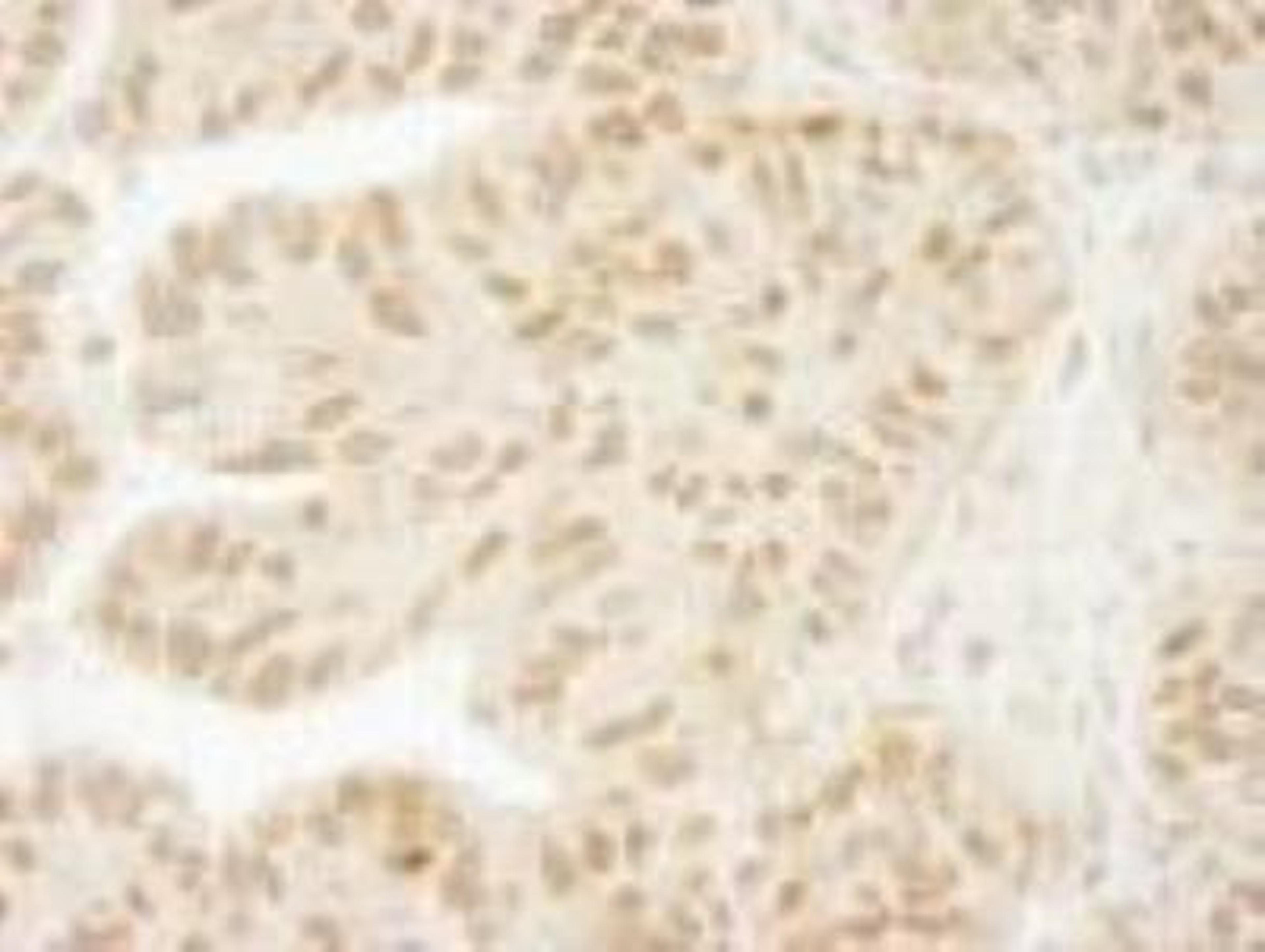 Immunohistochemistry-Paraffin: USP15 Antibody [NB110-40690] - FFPE section of human ovarian carcinoma.  Affinity purified rabbit anti-USP15 used at a dilution of 1:100.