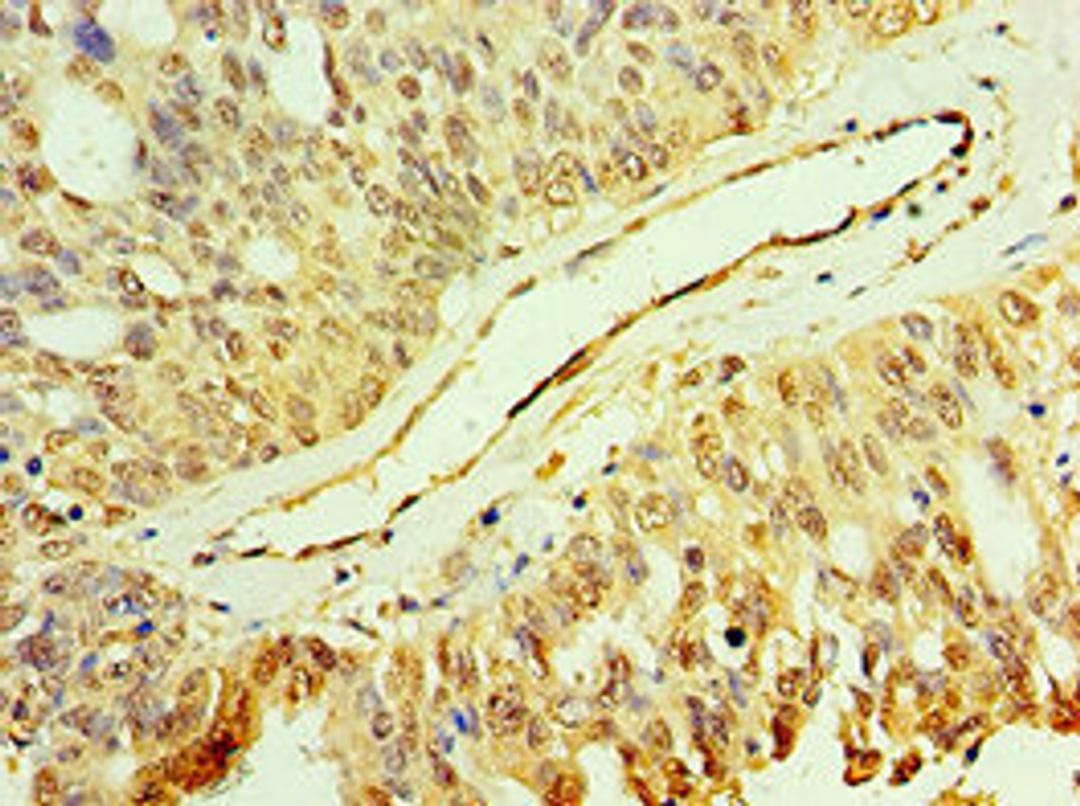 Immunohistochemistry of paraffin-embedded human endometrial cancer using CSB-PA013412ESR1HU at dilution of 1:100