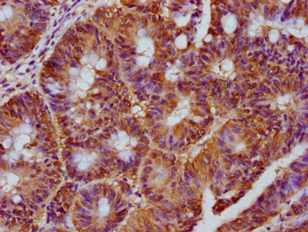 IHC image of CSB-PA863138LA01HU diluted at 1:300 and staining in paraffin-embedded human colon cancer performed on a Leica BondTM system. After dewaxing and hydration, antigen retrieval was mediated by high pressure in a citrate buffer (pH 6.0). Section was blocked with 10% normal goat serum 30min at RT. Then primary antibody (1% BSA) was incubated at 4°C overnight. The primary is detected by a biotinylated secondary antibody and visualized using an HRP conjugated SP system.
