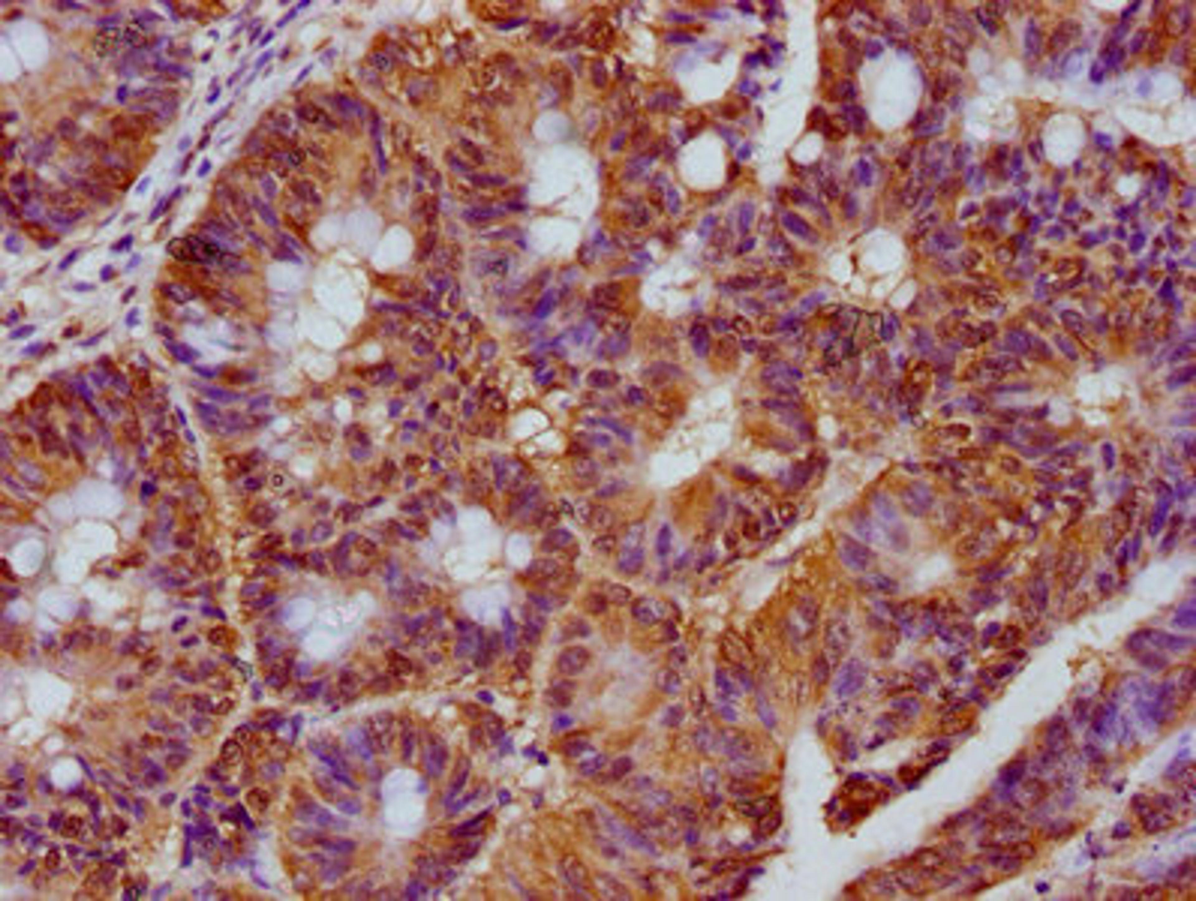IHC image of CSB-PA863138LA01HU diluted at 1:300 and staining in paraffin-embedded human colon cancer performed on a Leica BondTM system. After dewaxing and hydration, antigen retrieval was mediated by high pressure in a citrate buffer (pH 6.0). Section was blocked with 10% normal goat serum 30min at RT. Then primary antibody (1% BSA) was incubated at 4°C overnight. The primary is detected by a biotinylated secondary antibody and visualized using an HRP conjugated SP system.