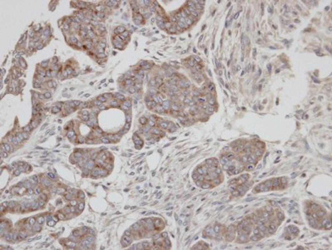 Immunohistochemistry-Paraffin: Rab2 Antibody [NBP1-31480] - Paraffin-embedded N87 xenograft, using antibody at 1:100 dilution.