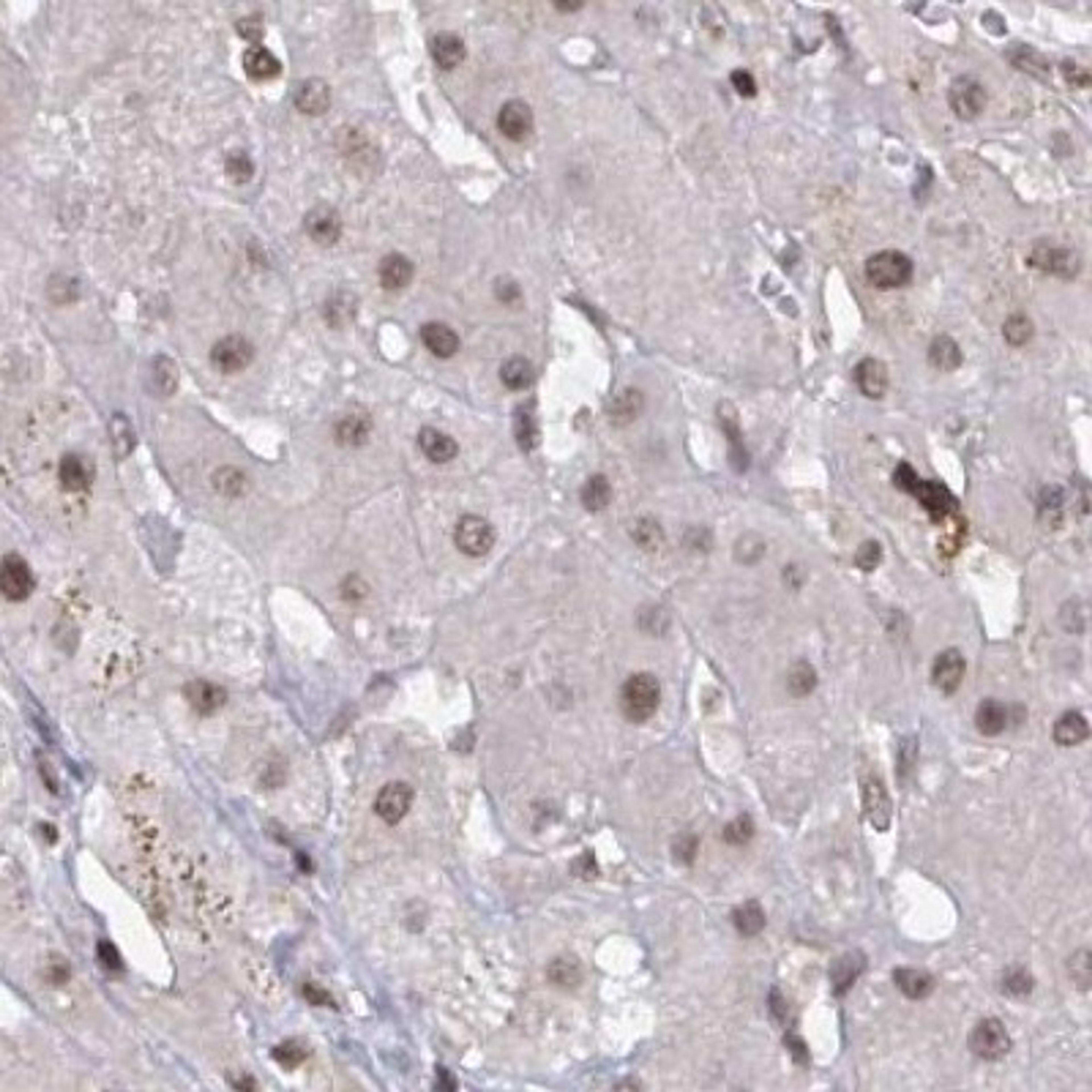 Immunohistochemistry: ZDHHC12 Antibody [NBP2-31763] - liver cancer