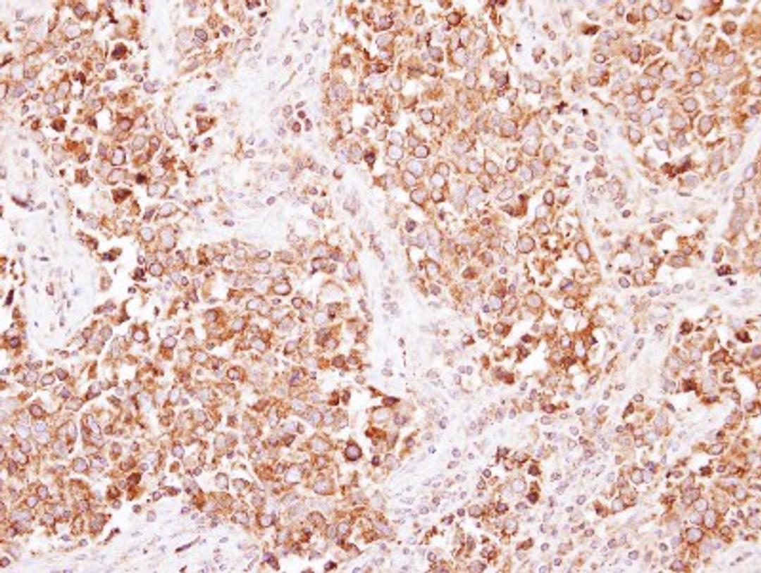 Immunohistochemistry-Paraffin: Beta 2 Adaptin Antibody [NBP2-15563] - Immunohistochemical analysis of paraffin-embedded Lung ADC, using antibody at 1:250 dilution.