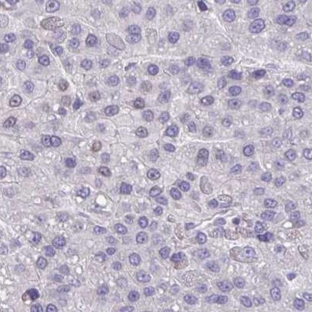 Immunohistochemistry: RUNDC3B Antibody [NBP2-31654] - liver cancer