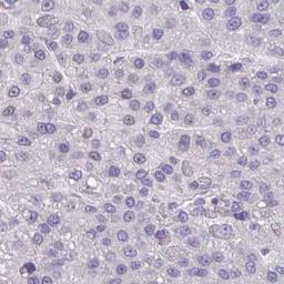 Immunohistochemistry: RUNDC3B Antibody [NBP2-31654] - liver cancer