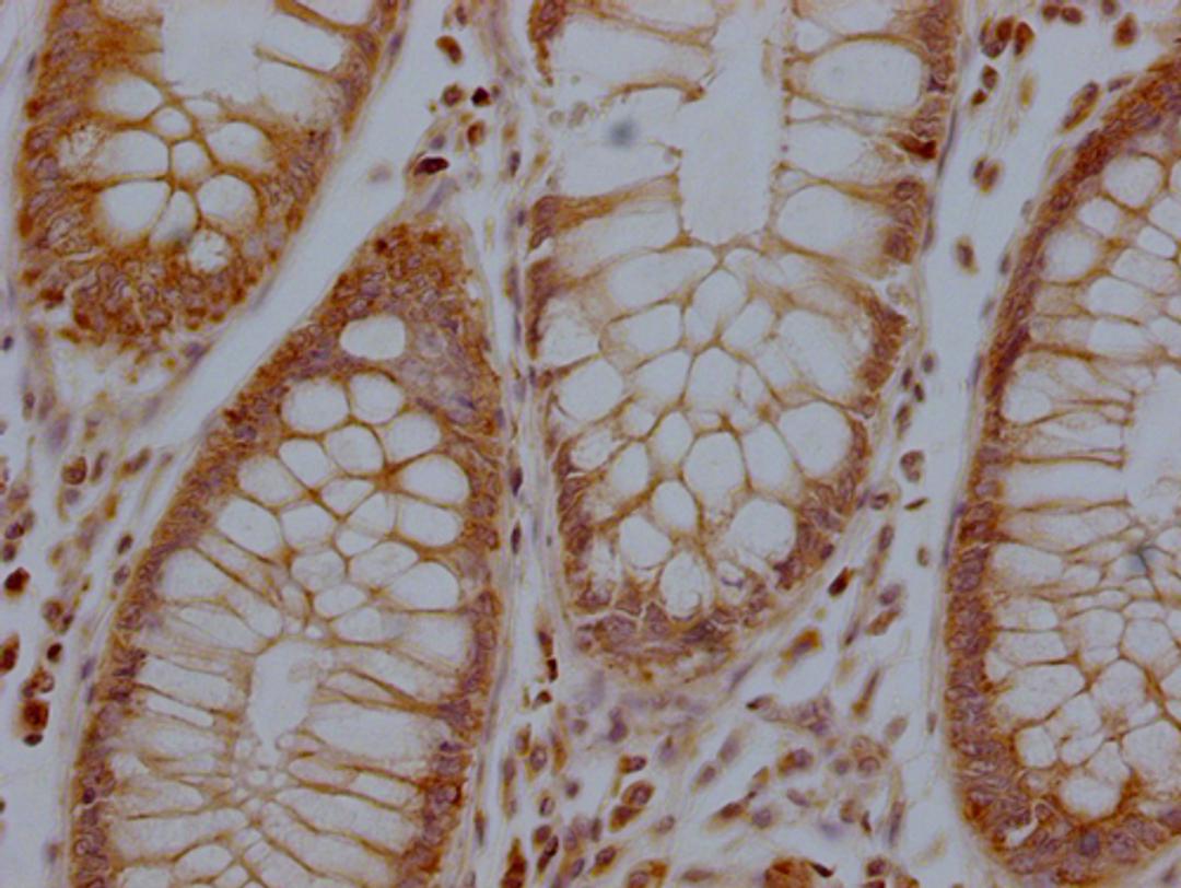 IHC image of CSB-PA744137LA01HU diluted at 1:100 and staining in paraffin-embedded human colon cancer performed on a Leica BondTM system. After dewaxing and hydration, antigen retrieval was mediated by high pressure in a citrate buffer (pH 6.0). Section was blocked with 10% normal goat serum 30min at RT. Then primary antibody (1% BSA) was incubated at 4°C overnight. The primary is detected by a Goat anti-rabbit polymer IgG labeled by HRP and visualized using 0.05% DAB.