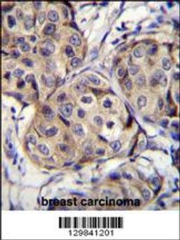 CBLN2 Antibody immunohistochemistry analysis in formalin fixed and paraffin embedded human breast carcinoma followed by peroxidase conjugation of the secondary antibody and DAB staining.