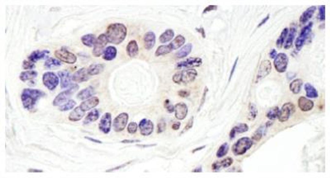 Immunohistochemistry-Paraffin: TDP1 Antibody [NB100-81642] - Section of human ovarian carcinoma. Dilution: 1:1,000 (0.2ug/ml).