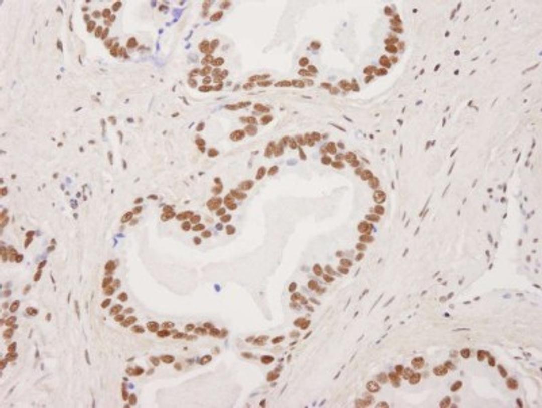 Immunohistochemistry-Paraffin: FUS Antibody [NB100-561] - Human prostate carcinoma.  Antibody used at a dilution of 1:1,000.