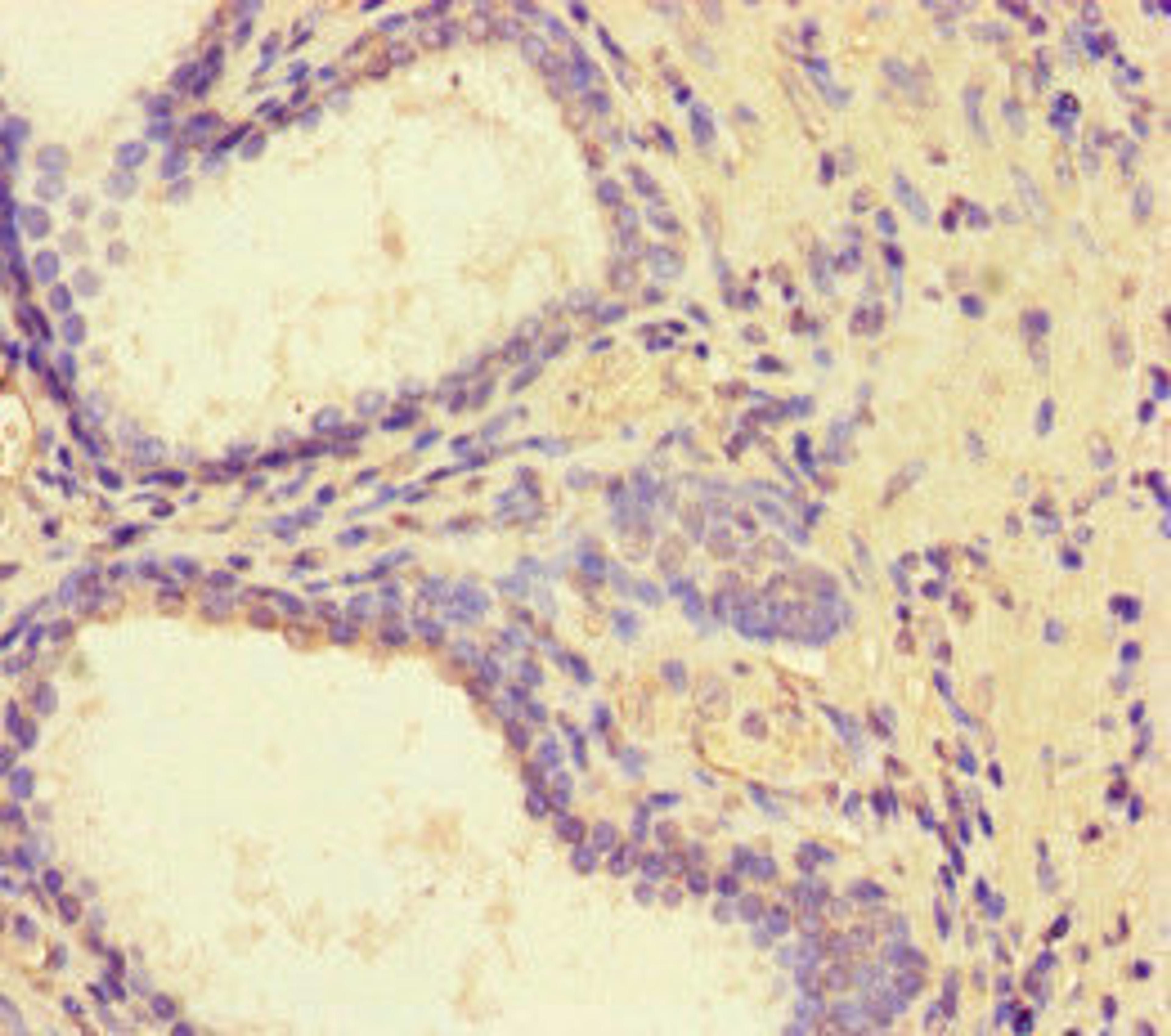 Immunohistochemistry of paraffin-embedded human prostate cancer using CSB-PA822223LA01HU at dilution of 1:100