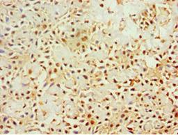 Immunohistochemistry of paraffin-embedded human breast cancer using CSB-PA012466ESR1HU at dilution of 1:100