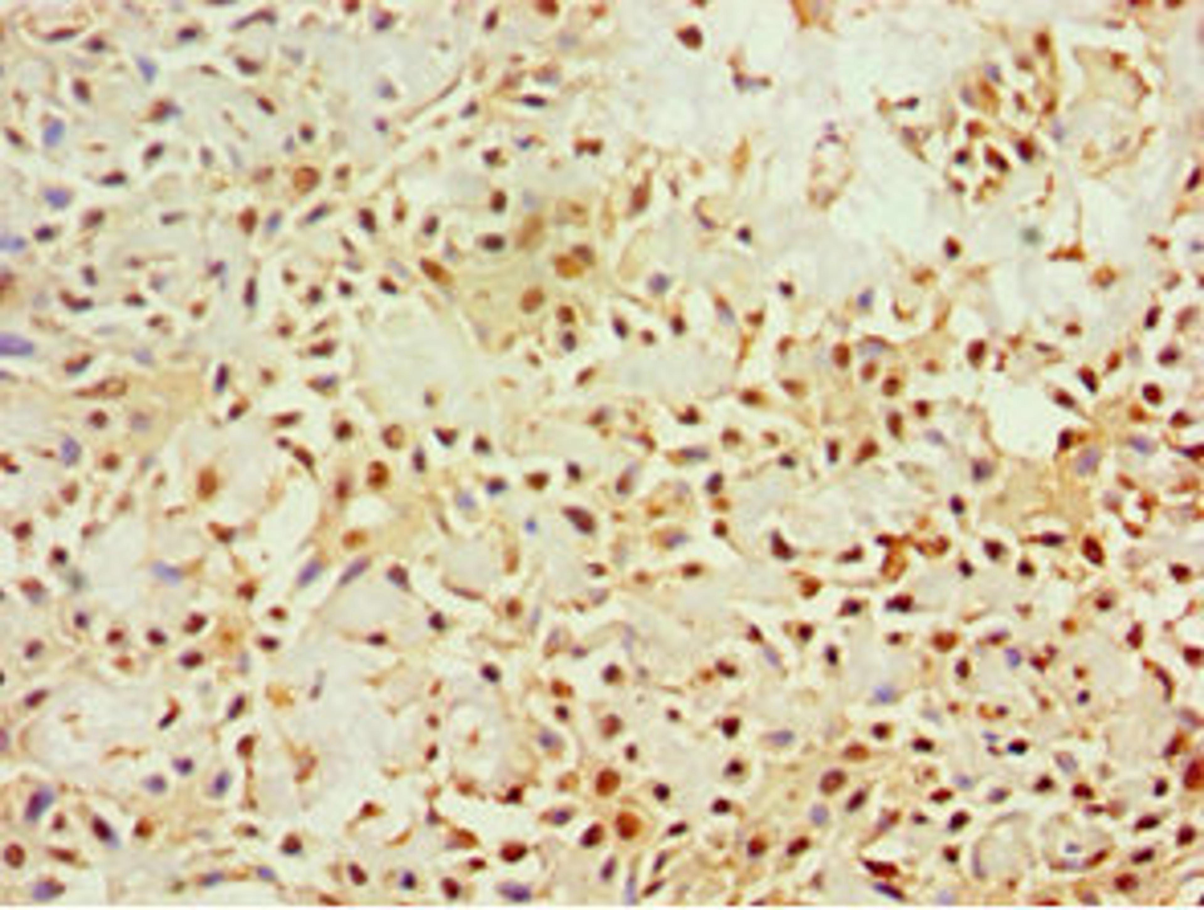 Immunohistochemistry of paraffin-embedded human breast cancer using CSB-PA012466ESR1HU at dilution of 1:100