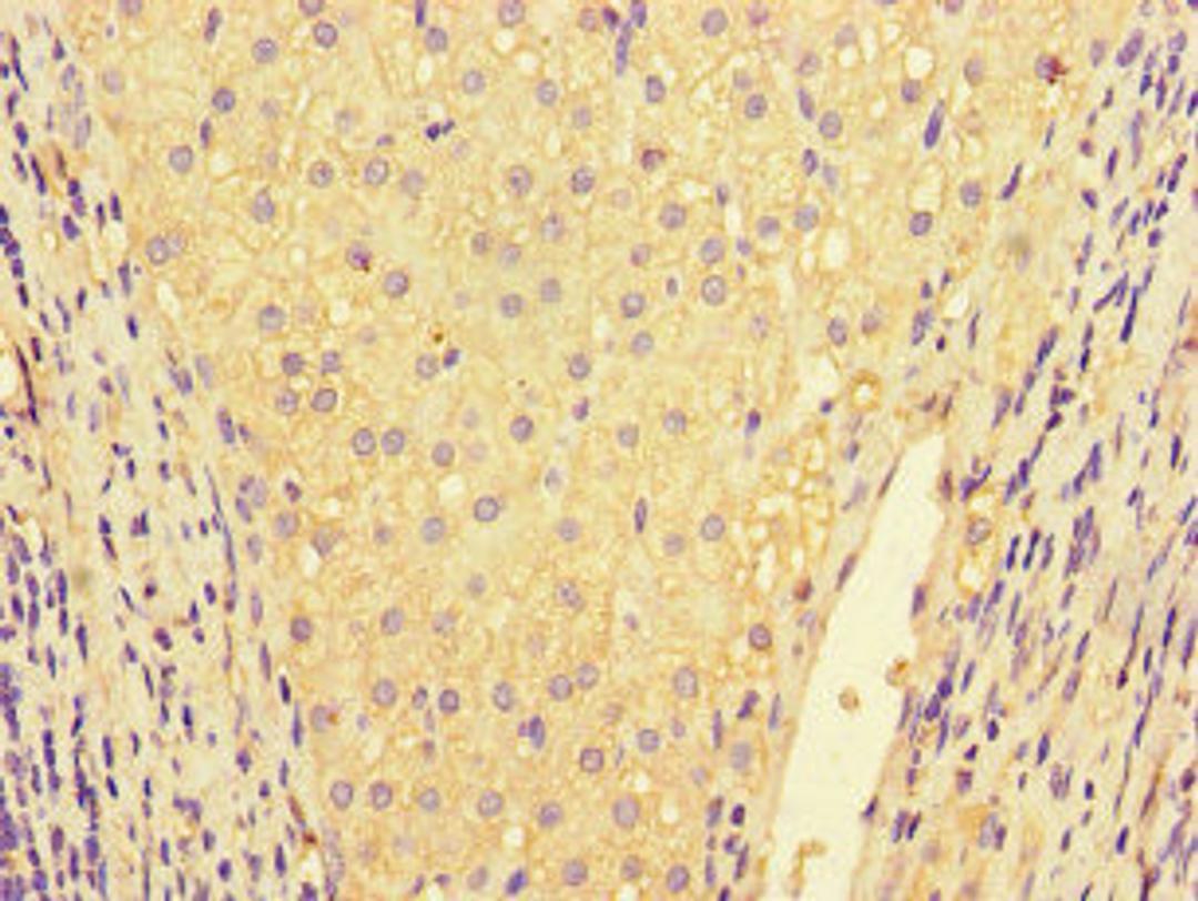 Immunohistochemistry of paraffin-embedded human liver cancer using CSB-PA08309A0Rb at dilution of 1:100